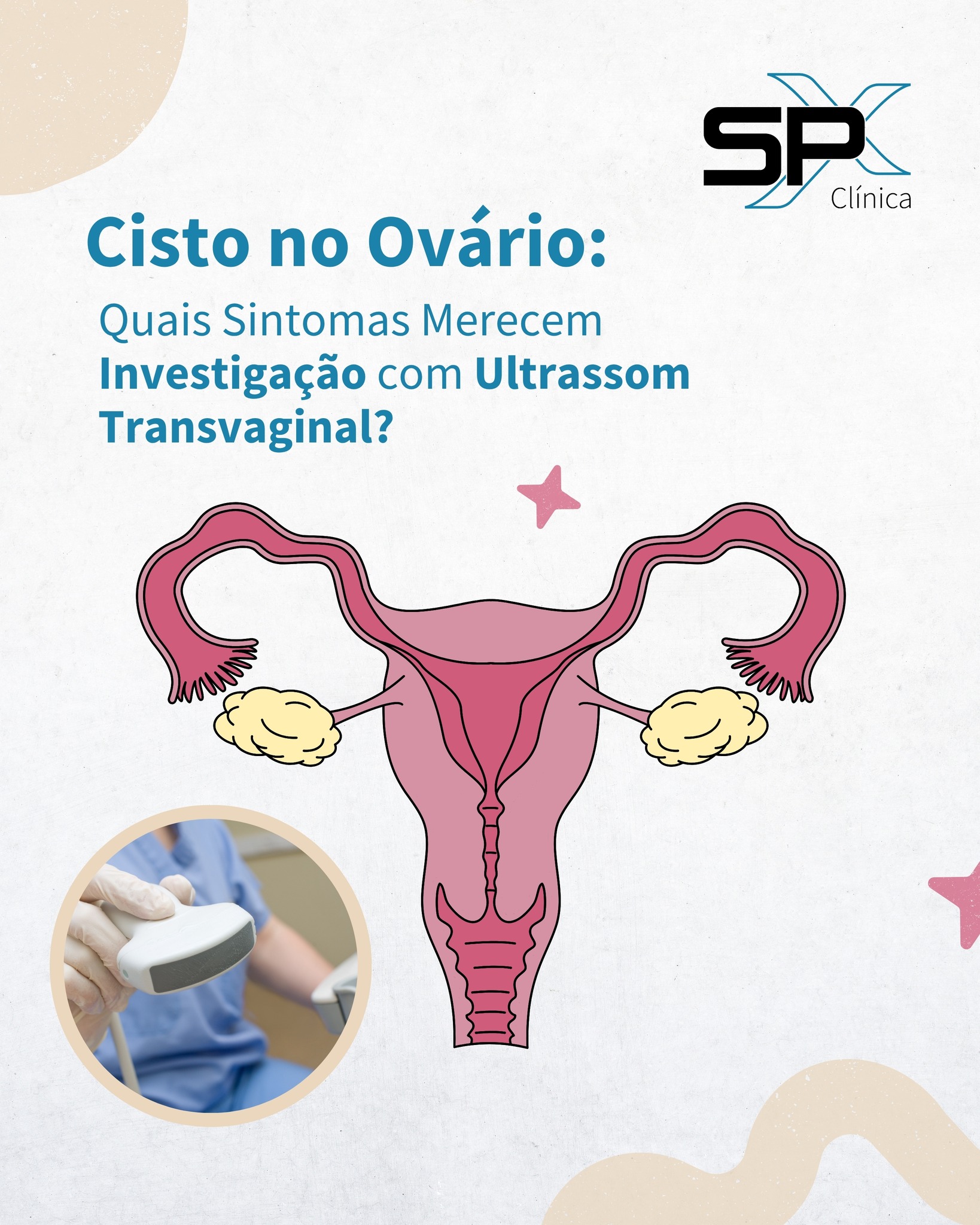 SPX - 🌸 Cisto no Ovário: Quais Sintomas Merecem Investigação com ...