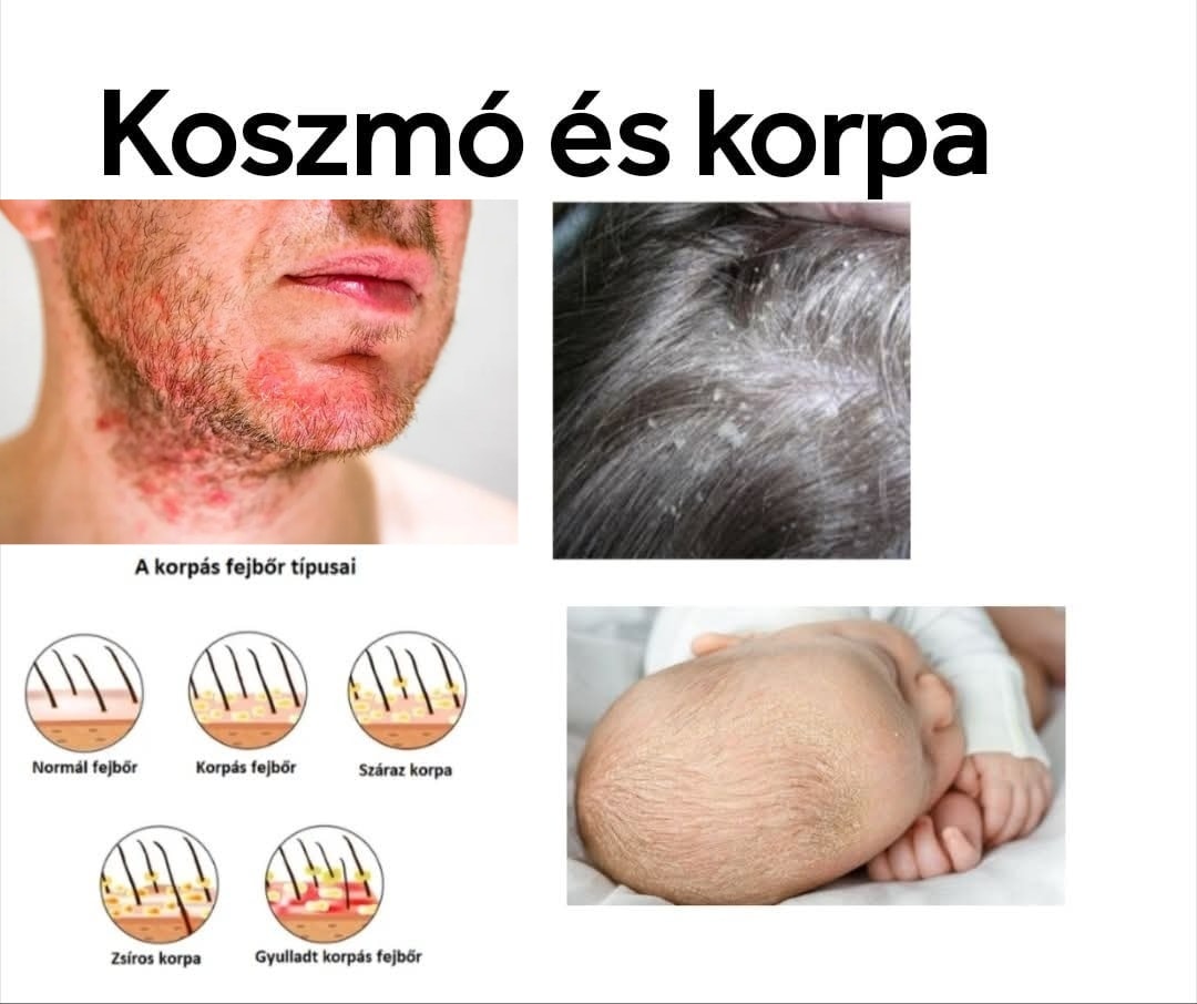 Dr. - Hisztaminérzékenység csecsemőknél és anyáknál – amikor két ...