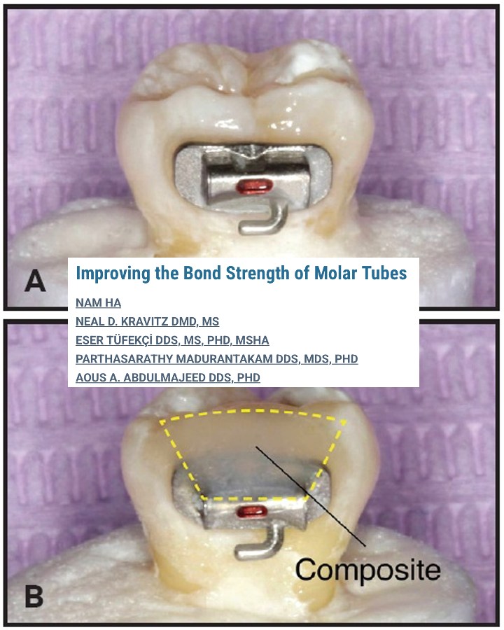JCO - While repeated failures of bonded molar tubes can be exasperating ...