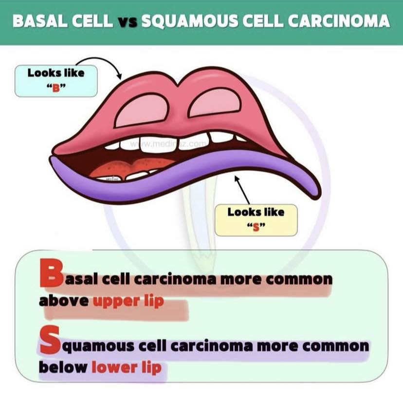 Cardiophilia - 👩‍⚕️Basal vs Squamous cell Carcinoma 👄 | Facebook
