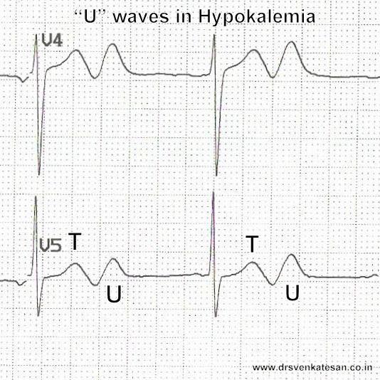 Cardiophilia - ECG features of hypokalaemia -U waves -small or absent T ...