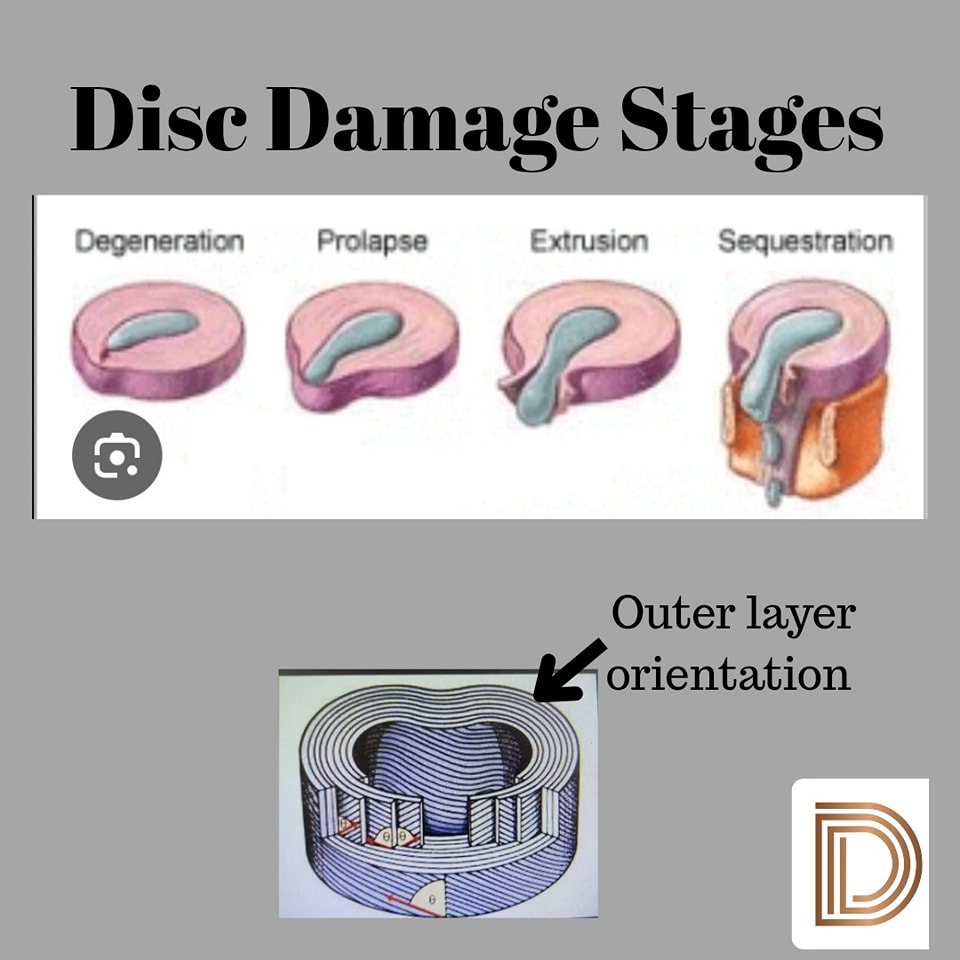 Dr. - Part 1: How do disc injuries happen? I'm sure you've heard the ...