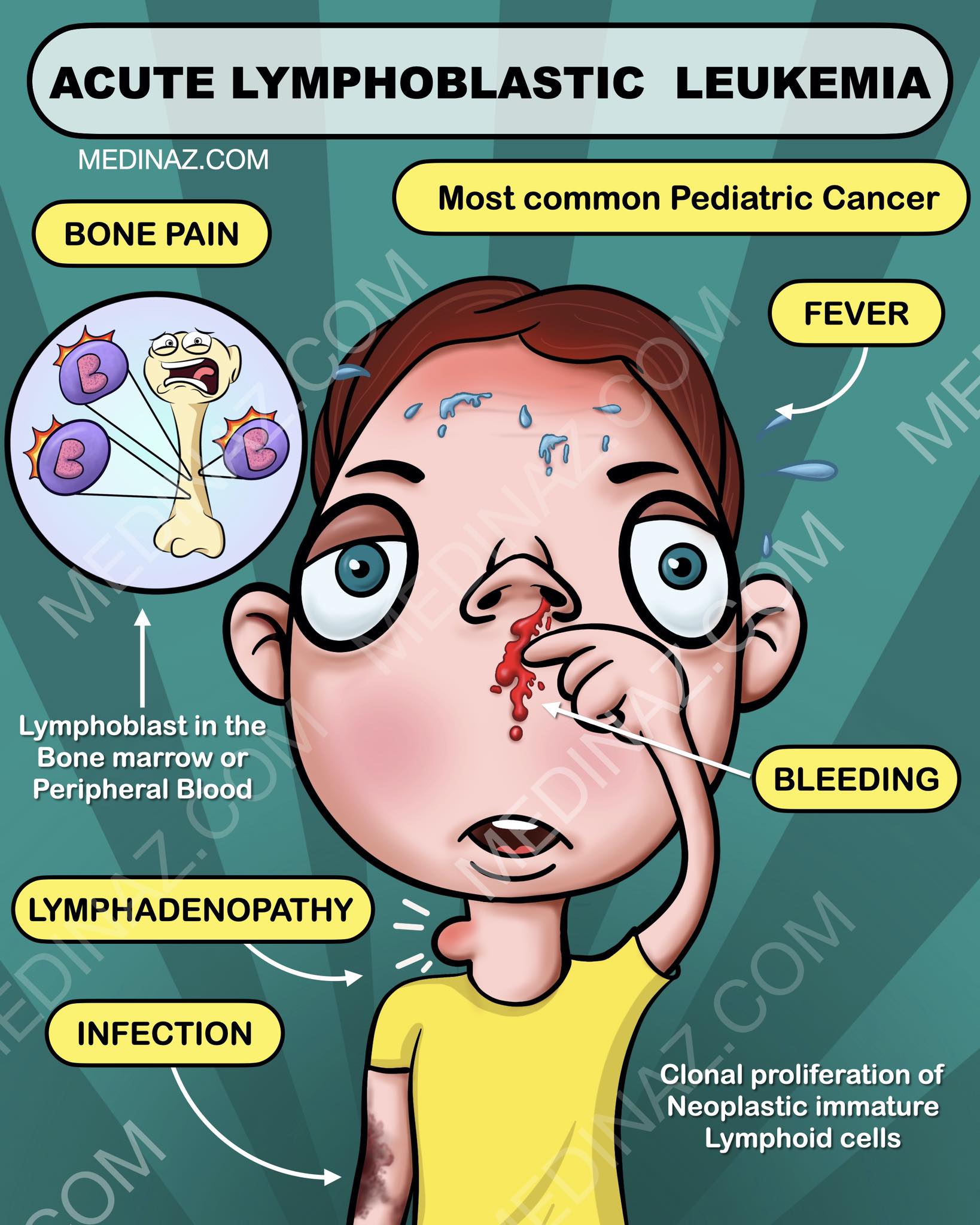 Medinaz - Acute Lymphoblastic Lymphoma | Facebook