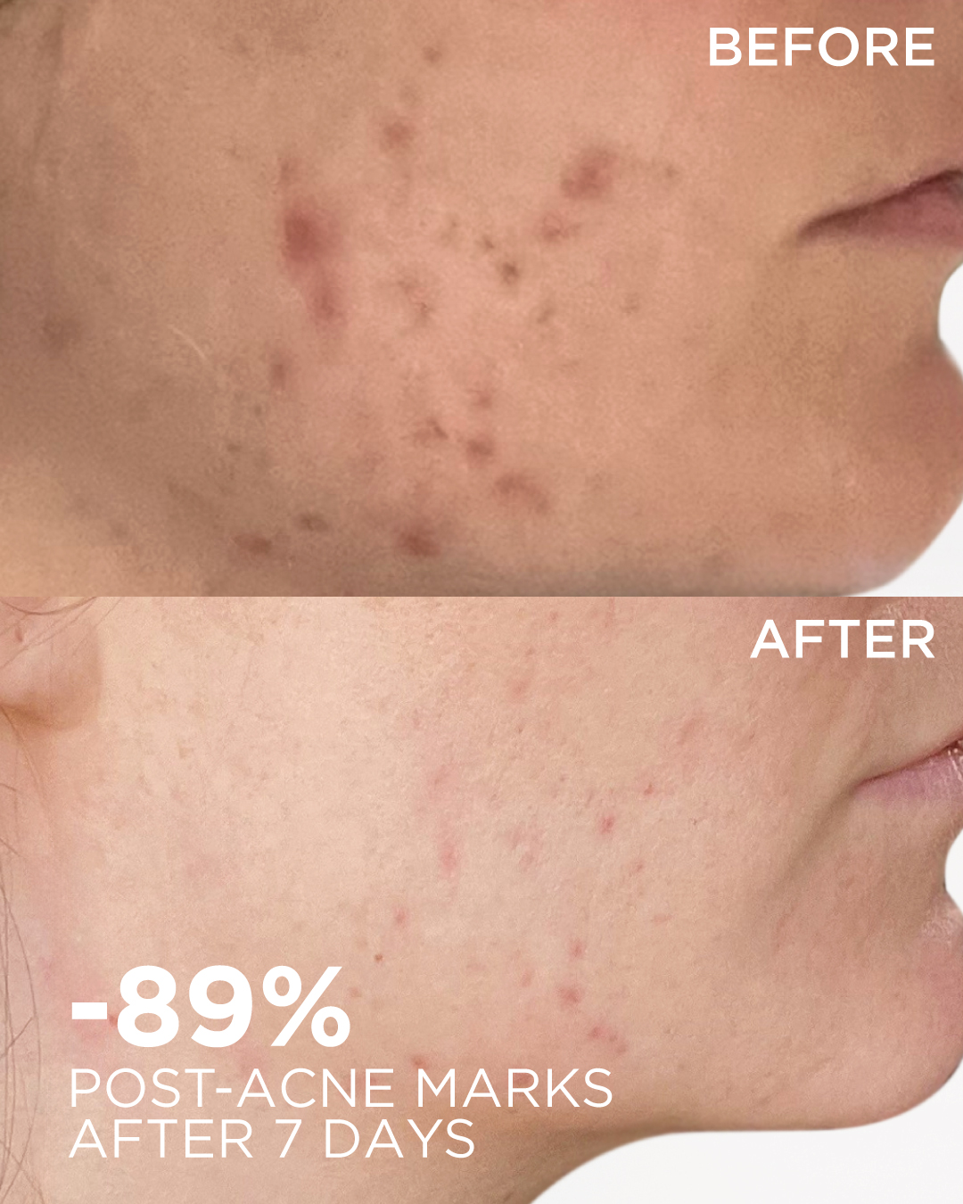 BIODERMA - The perfect acne-free routine? Start with... | Facebook