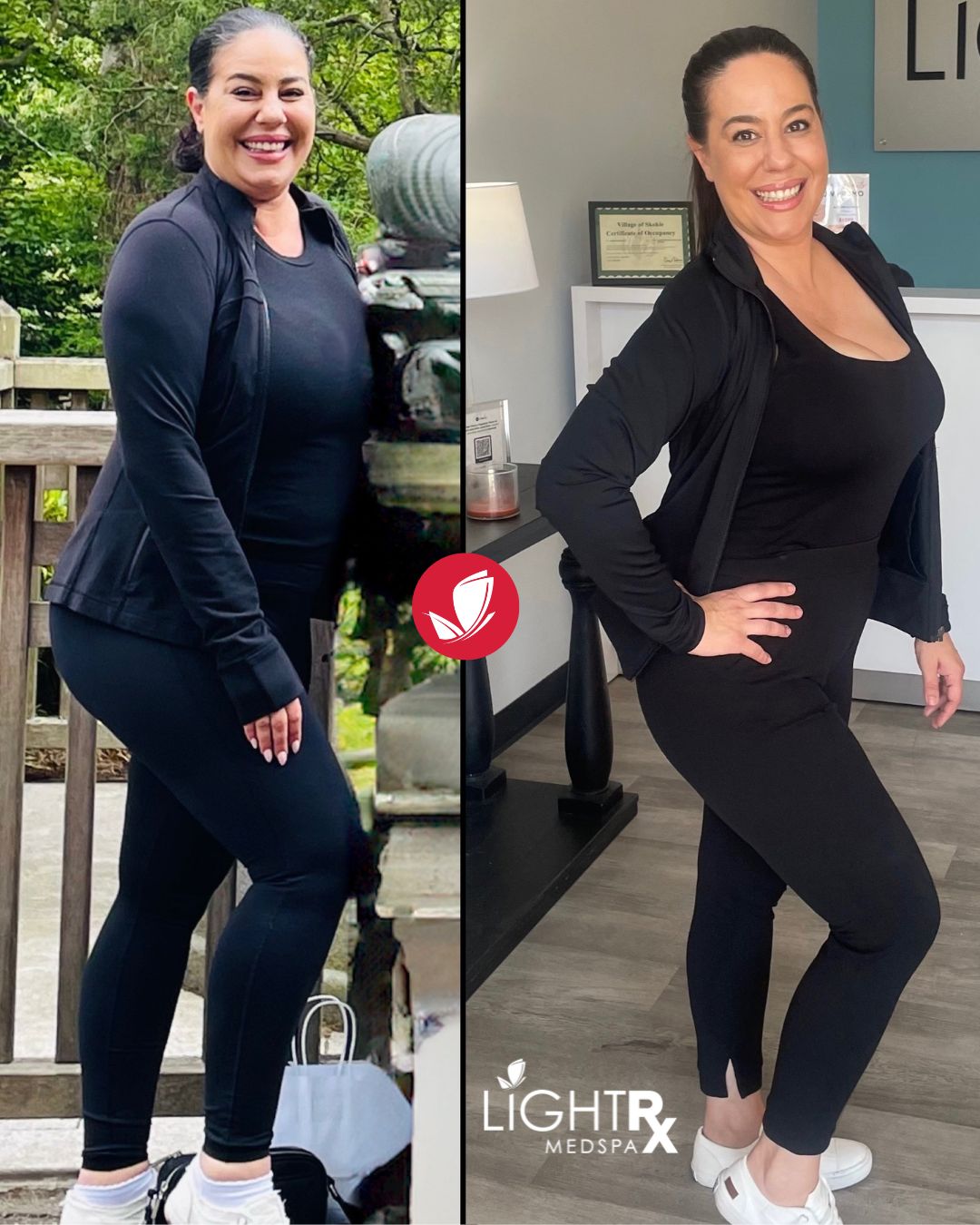glp 1 sculpt touch reviews before and after Why CoolSculpting is the Secret to Post-Weight Loss Success VOL.U.LIFT GLP-1 4D Skin Rebound