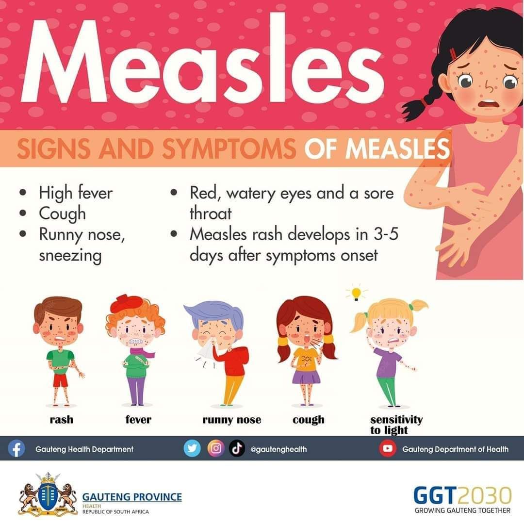 Tshwane - Signs and symptoms of Measles include cough, high fever, red ...
