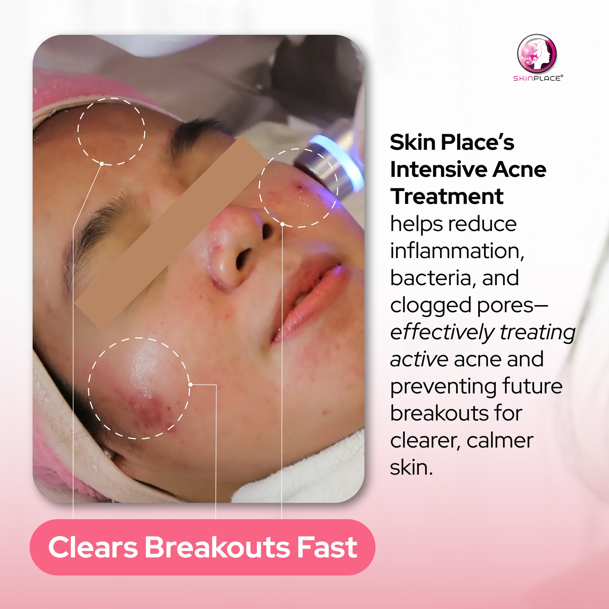Skin Place - Rejuvenate your skin! Rejuvenate, tighten and lift your ...