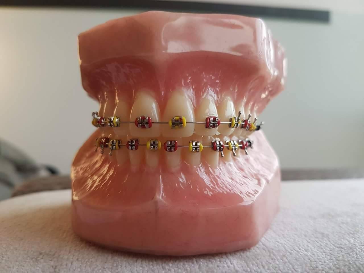 Echano - #BRACES Package Installment Package as Low as 5,000 ...