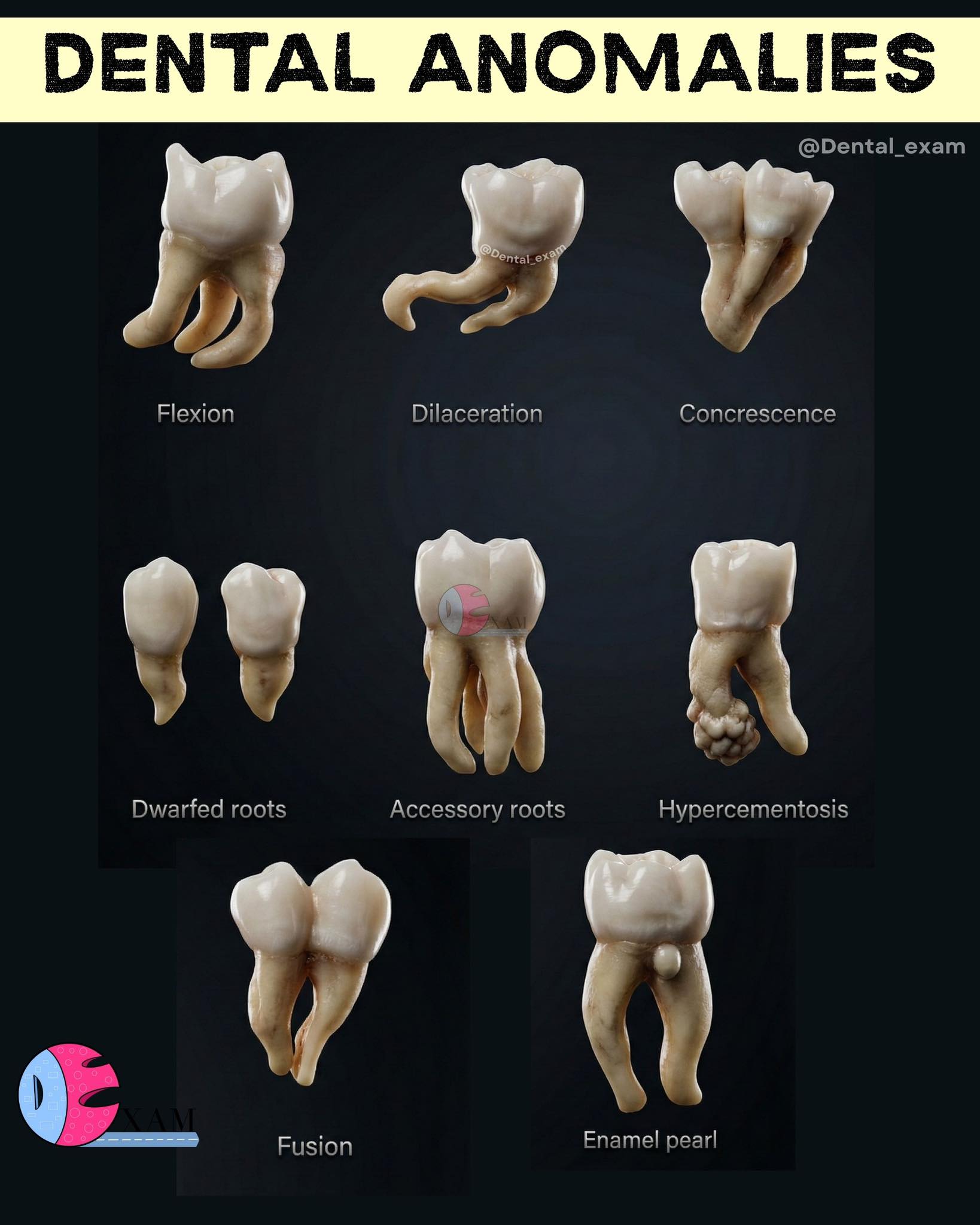 Dental - Dental Abnormalities ⬇️ Flexion: A developmental deviation or ...