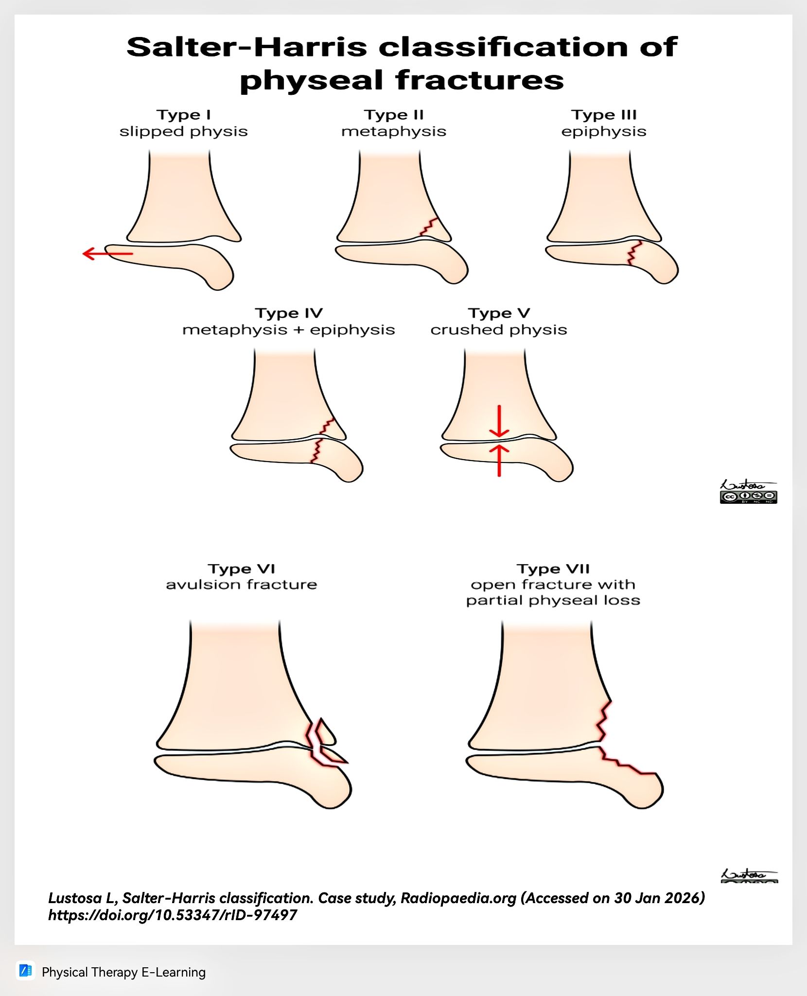 Physical - Salter-Harris classification is used to describe physeal ...