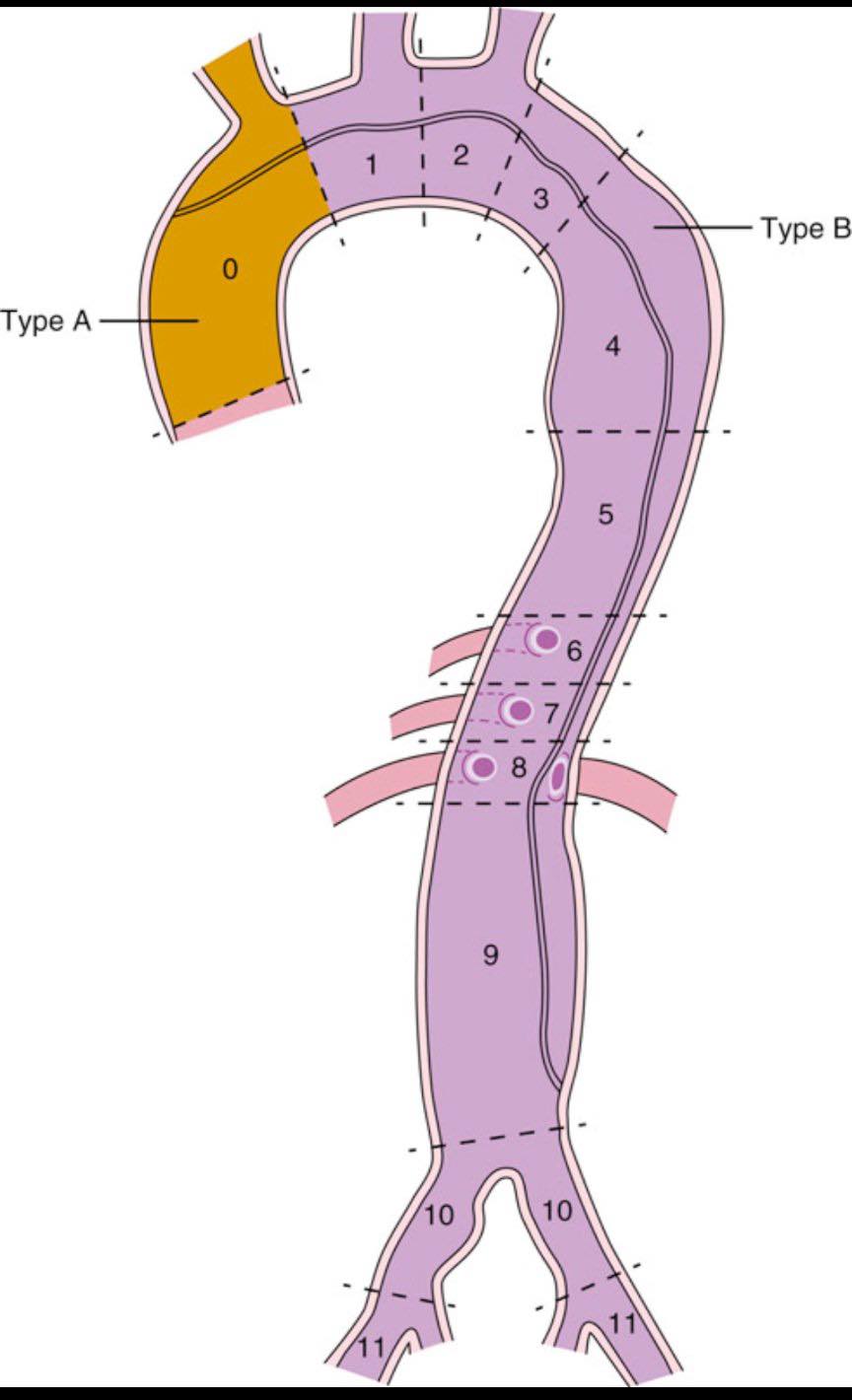 Cardiophilia - SVS/STS Aortic Dissection Classification... | Facebook
