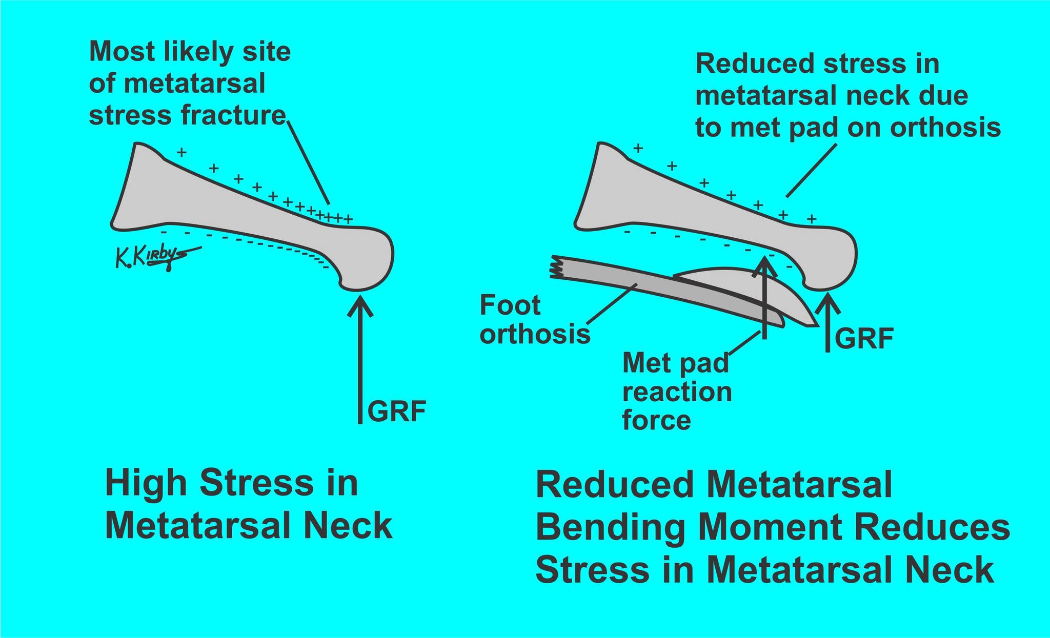 Kevin - With injuries to the plantar plate of the 2nd ...