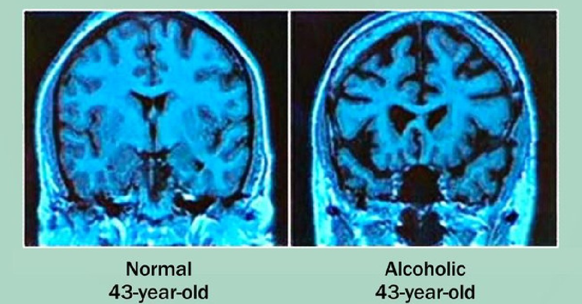 WebMD - Heavy drinking over a long time can shrink brain... | Facebook