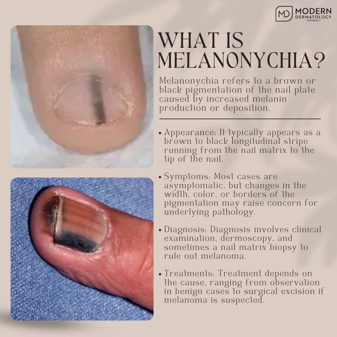 What is melanonychia and its symptoms