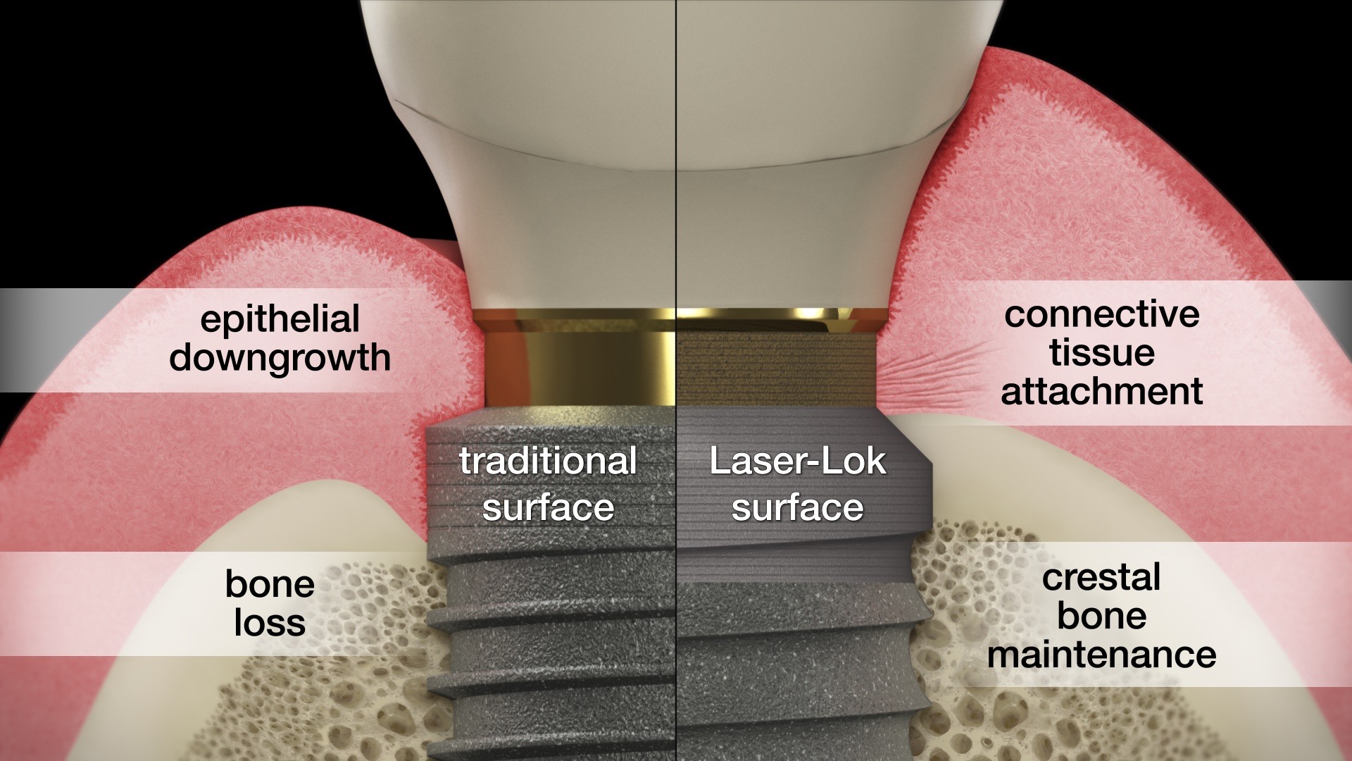 BioHorizons - The Laser-Lok surface is different than... | Facebook