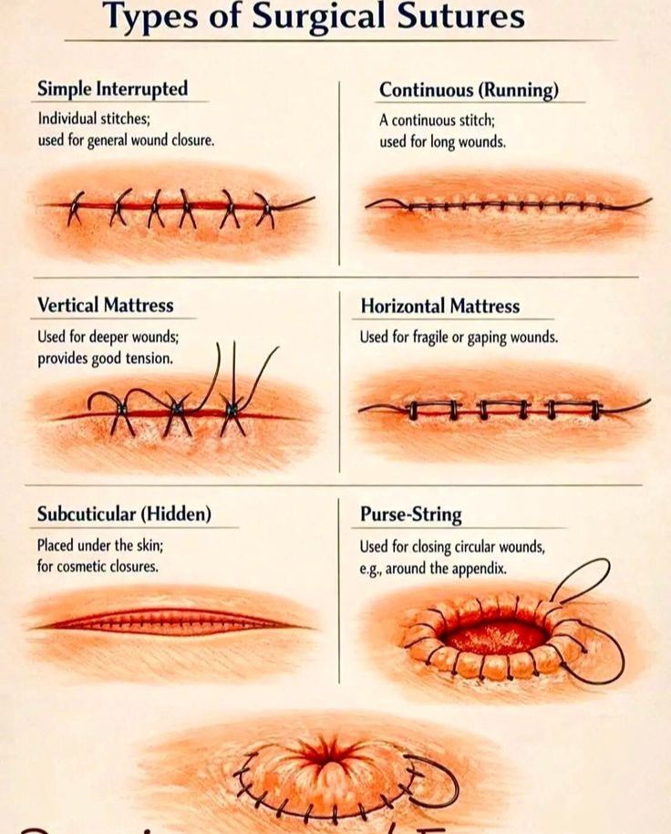 Biology - Types of Sutures 🧵🩺 Sutures are medical threads used to close ...