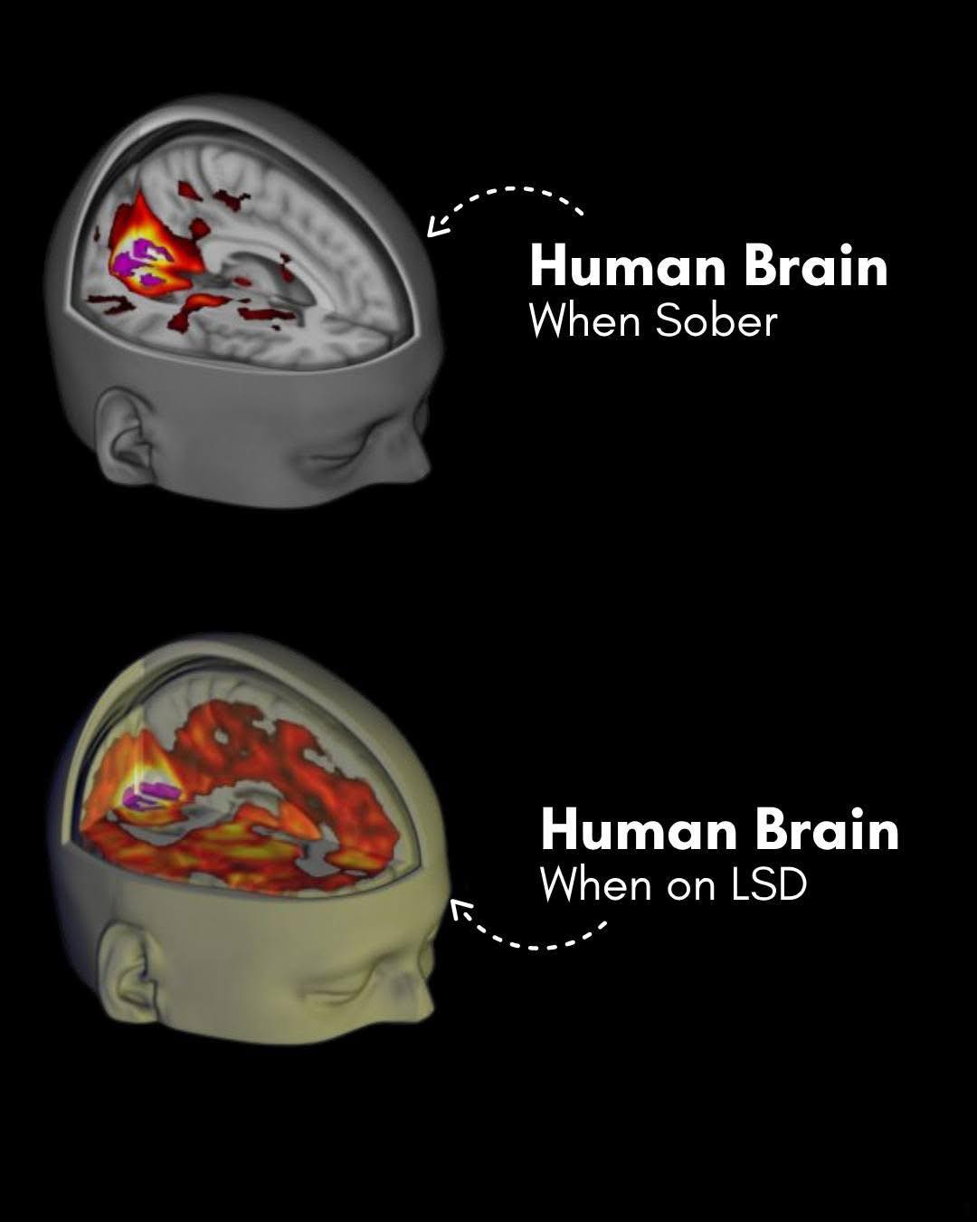 Dream - 🧠 World-first brain scans reveal how LSD reshapes the human ...