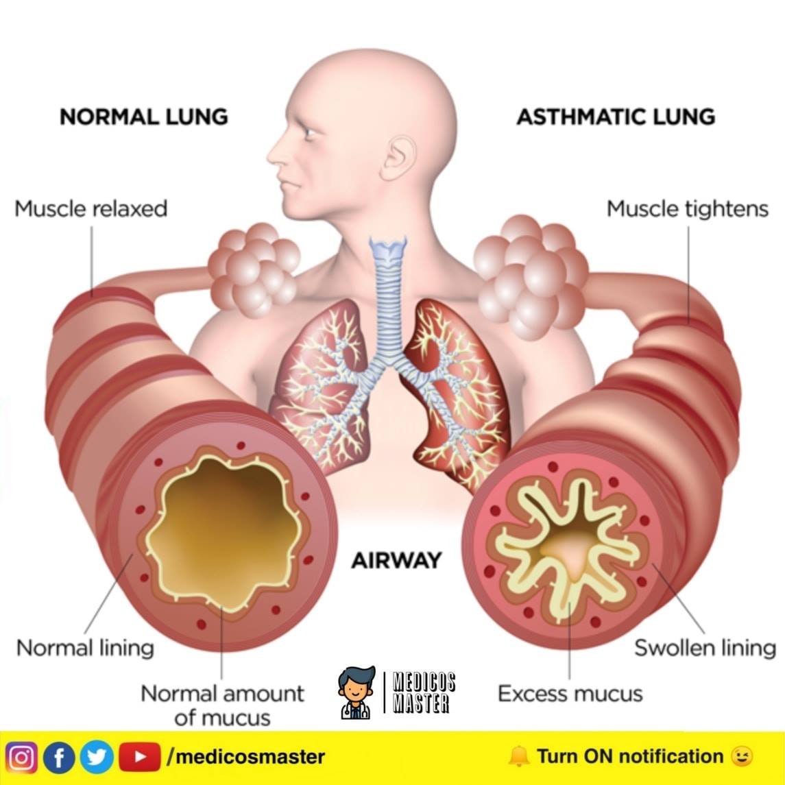 Medicos Master - What is jugular vein distention? Jugular vein ...
