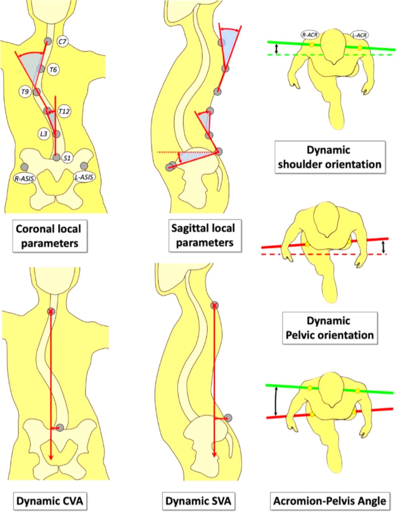 M.R - #Scoliosis #Gait #affected Before we start to know the impact ...