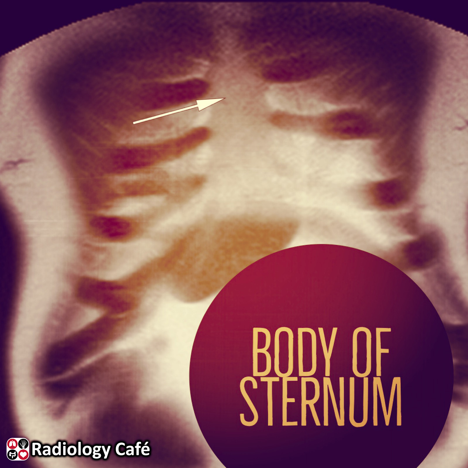 Radiology Cafe - Answer for yesterday's question: Body of... | Facebook