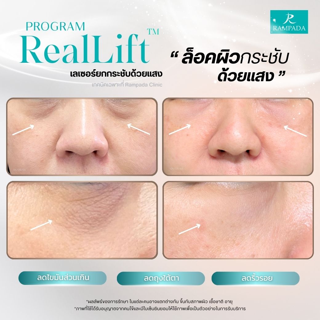 Rampada - เพราะดวงตาคือจุดแรกที่บอกความอ่อนเยาว์ โปรแกรม RealLift ช่วย ...