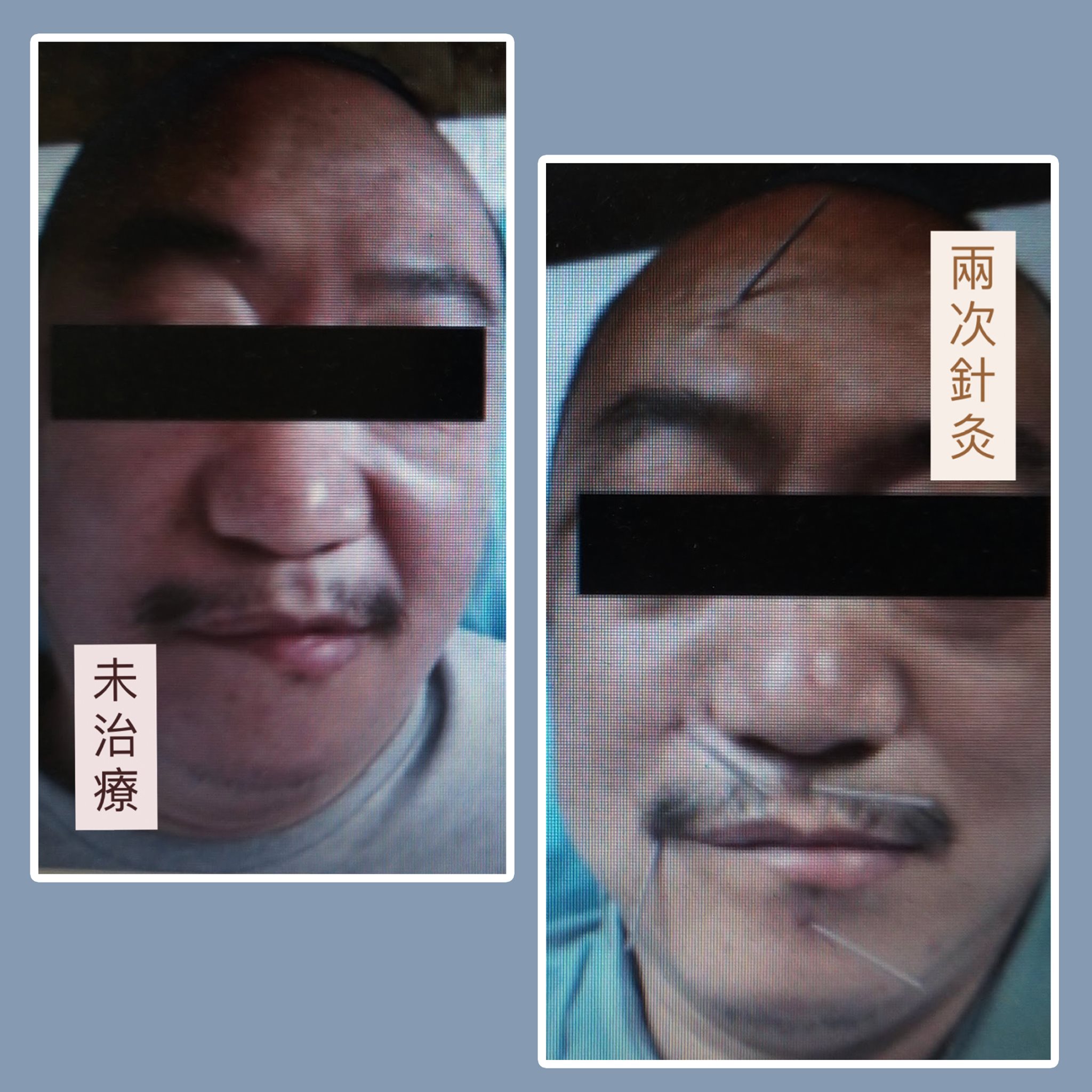 栢健中醫-紅磚醫師診所 - 面癱的出現非常突然，未必與中風有關，有時感染風寒或免疫力下降，也會引致顏面神經麻痺。假如不... | Facebook