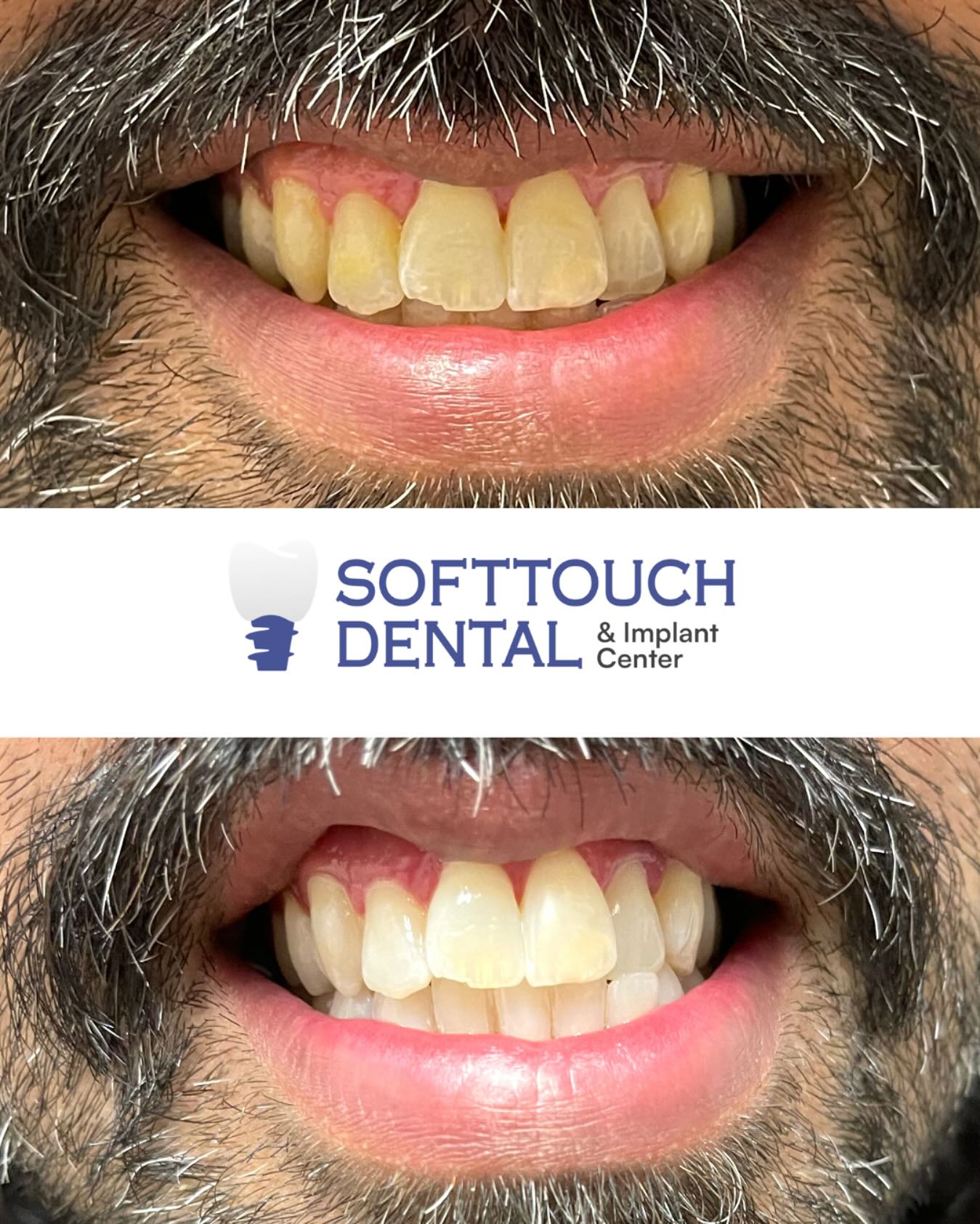 Softtouch Dental and Implant Center | Plano TX