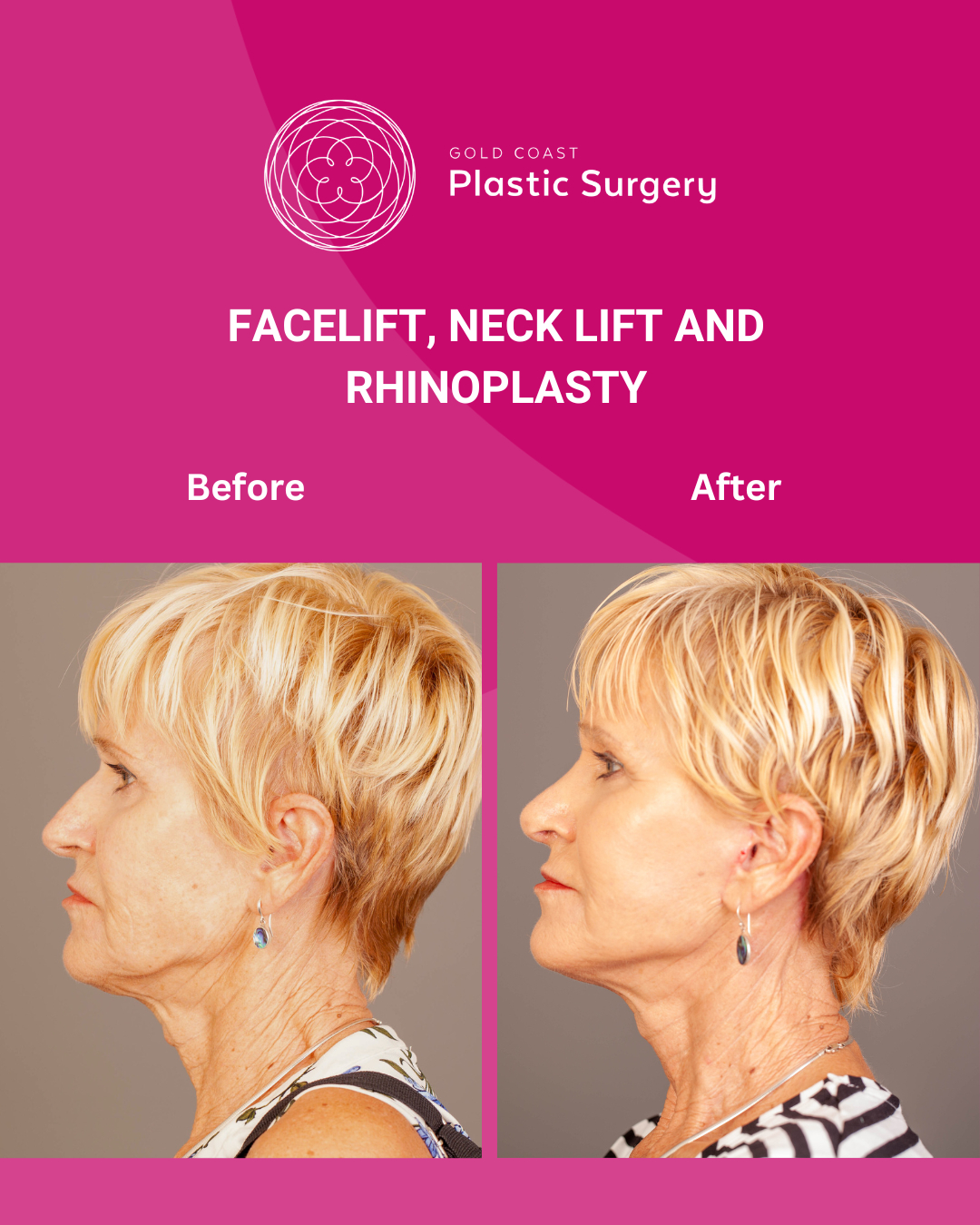 Gold - Facelift, rhinoplasty and neck lift surgery before and after ...