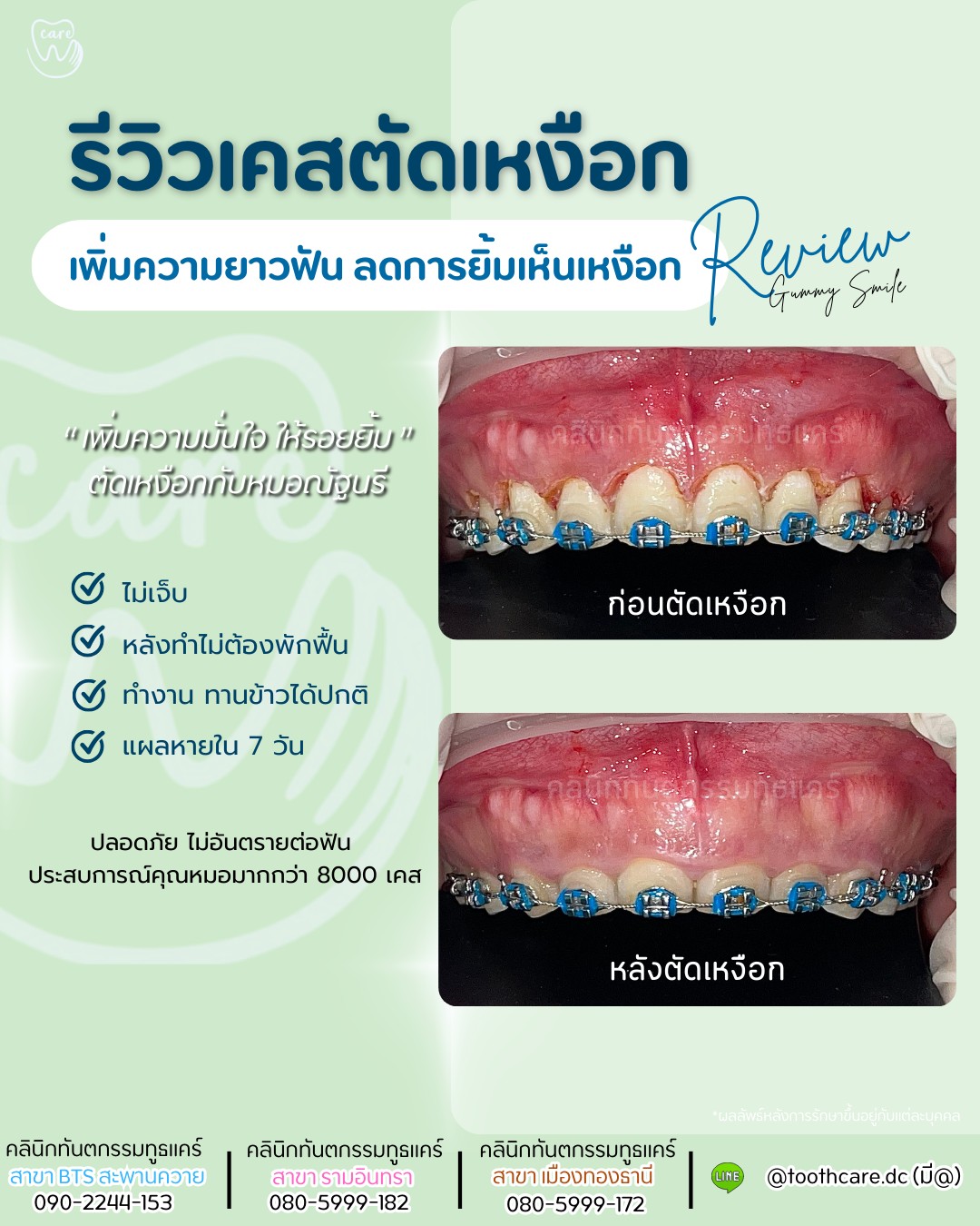 🥰รีวิวเคสตัดเหงือก🥰 แก้ไขฟันสั้น ยิ้มเห็นเหงือก เพิ่มความมั่นใจ 🧡ไม่ ...