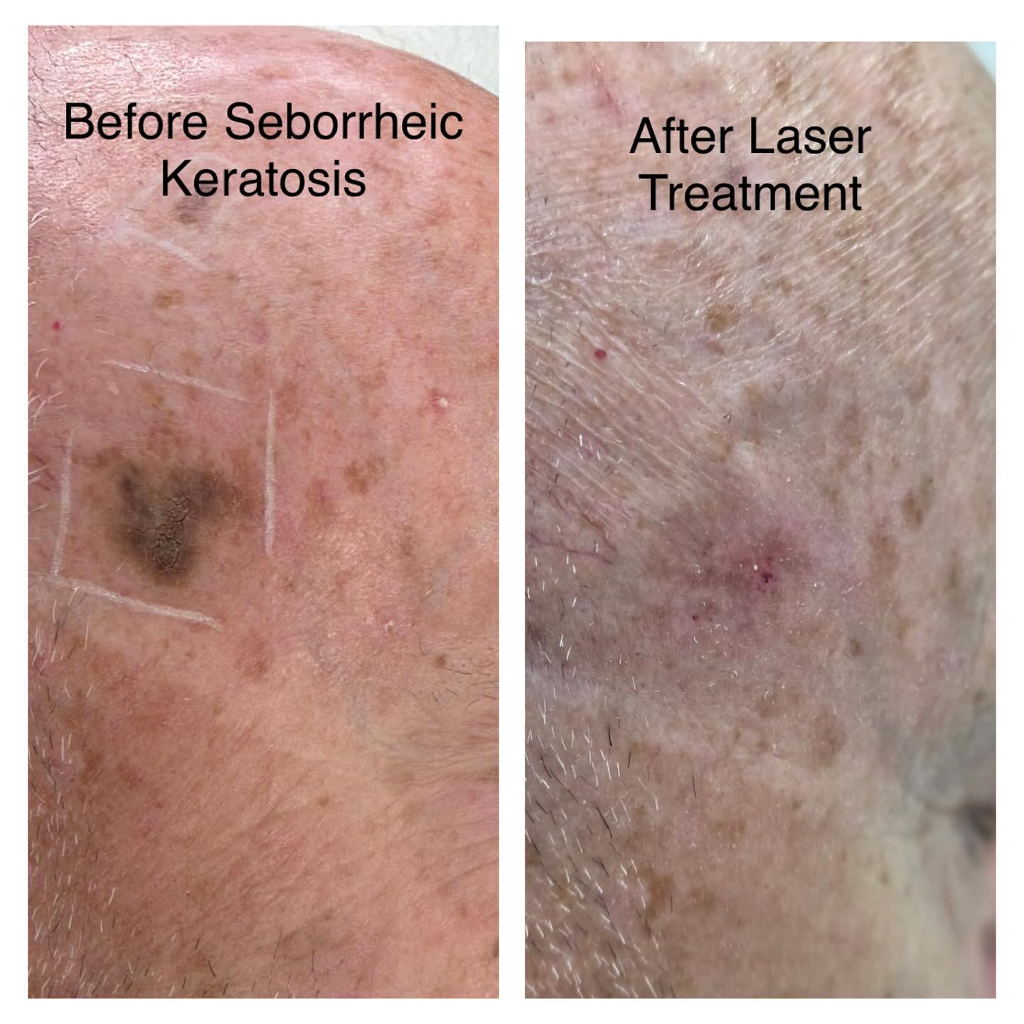 City - Seborrhoeic keratosis are harmless, but when they appear in ...