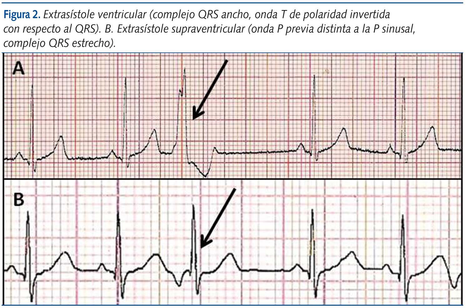 Enfermería, - Las extrasístoles ventriculares1 tienen un complejo QRS ...