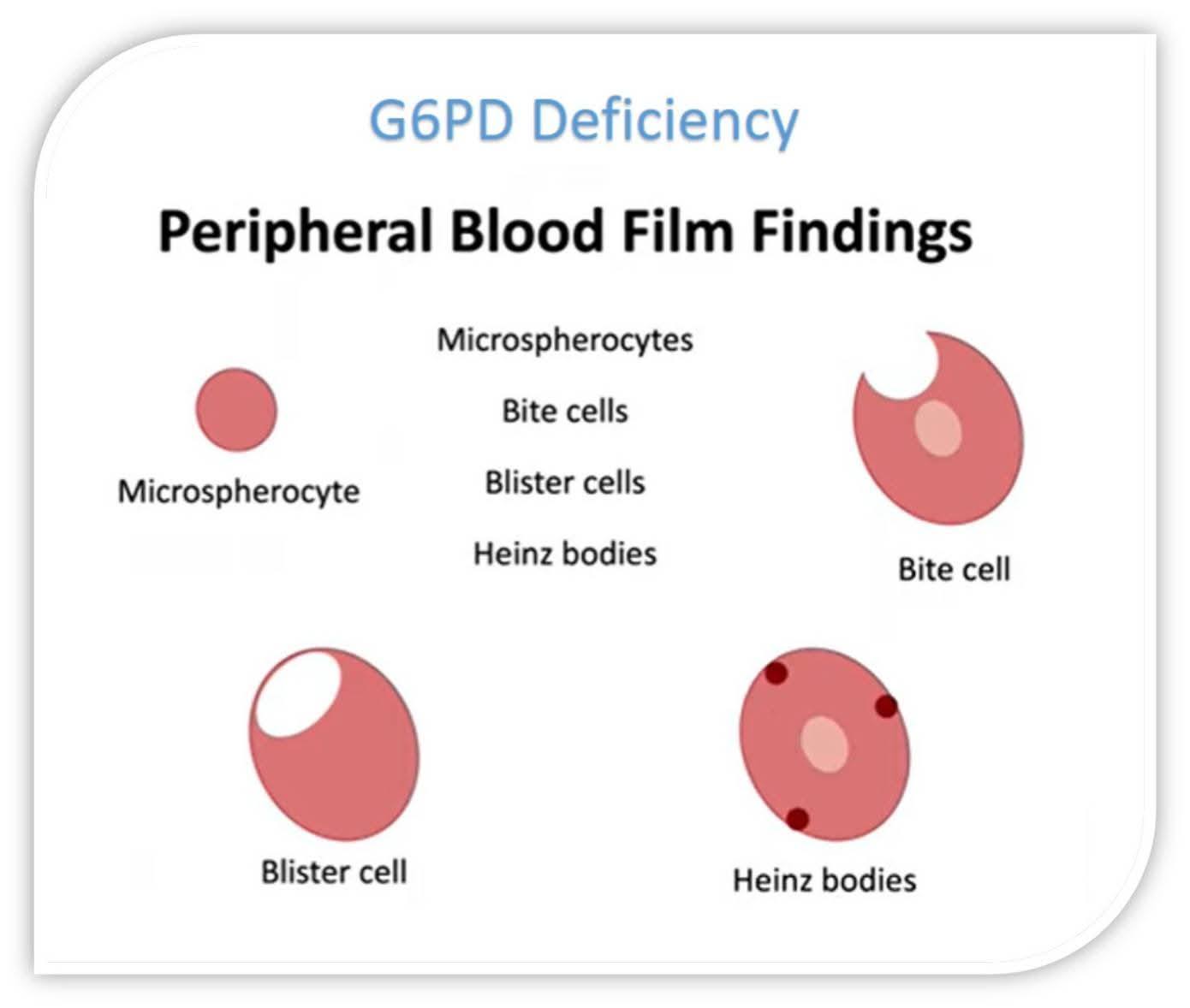 glutathione synthetase deficiency blood smear G6PD causes blister cells and bite cells in red cells Quantity:2 Months Supply Detection and in vitro Macwhite Bar price in Pakistan