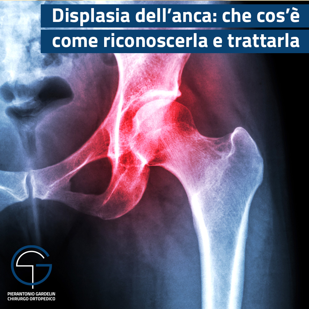 La #displasia dell’#anca è una condizione caratterizzata dalla tendenza ...