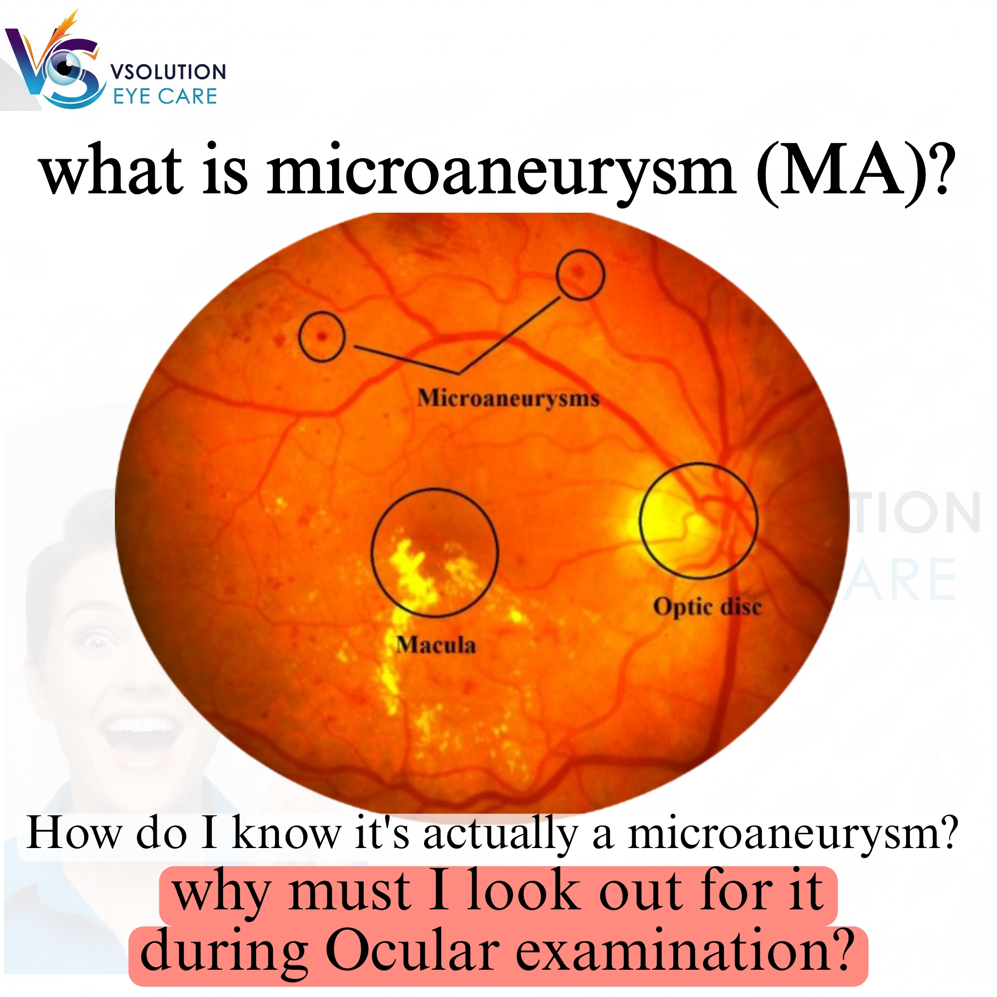 A fundus microaneurysm (MA) is a tiny area of swelling or 