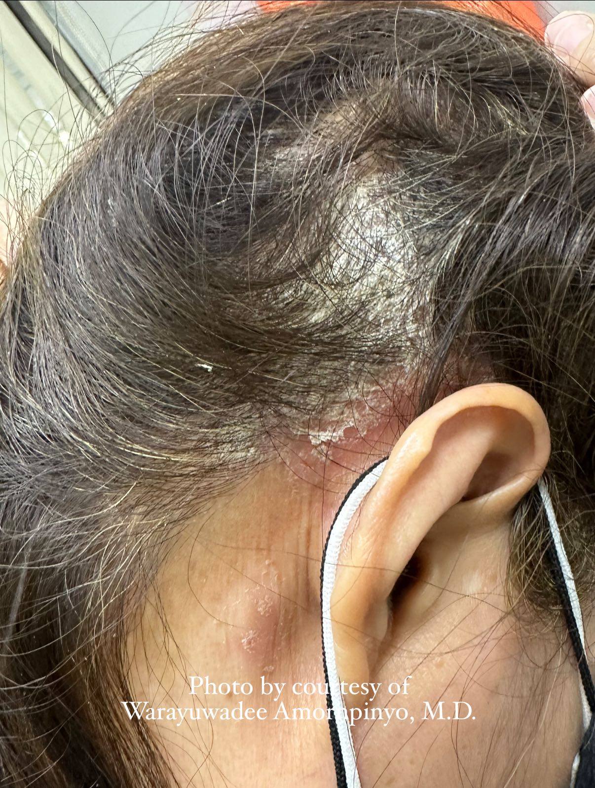 HELLO SKIN by หมอผิวหนัง - [ APPROACH TO Retiform Purpura ] 🦠🦠🦠🦠🦠🦠🦠🦠🦠🦠🦠 ...