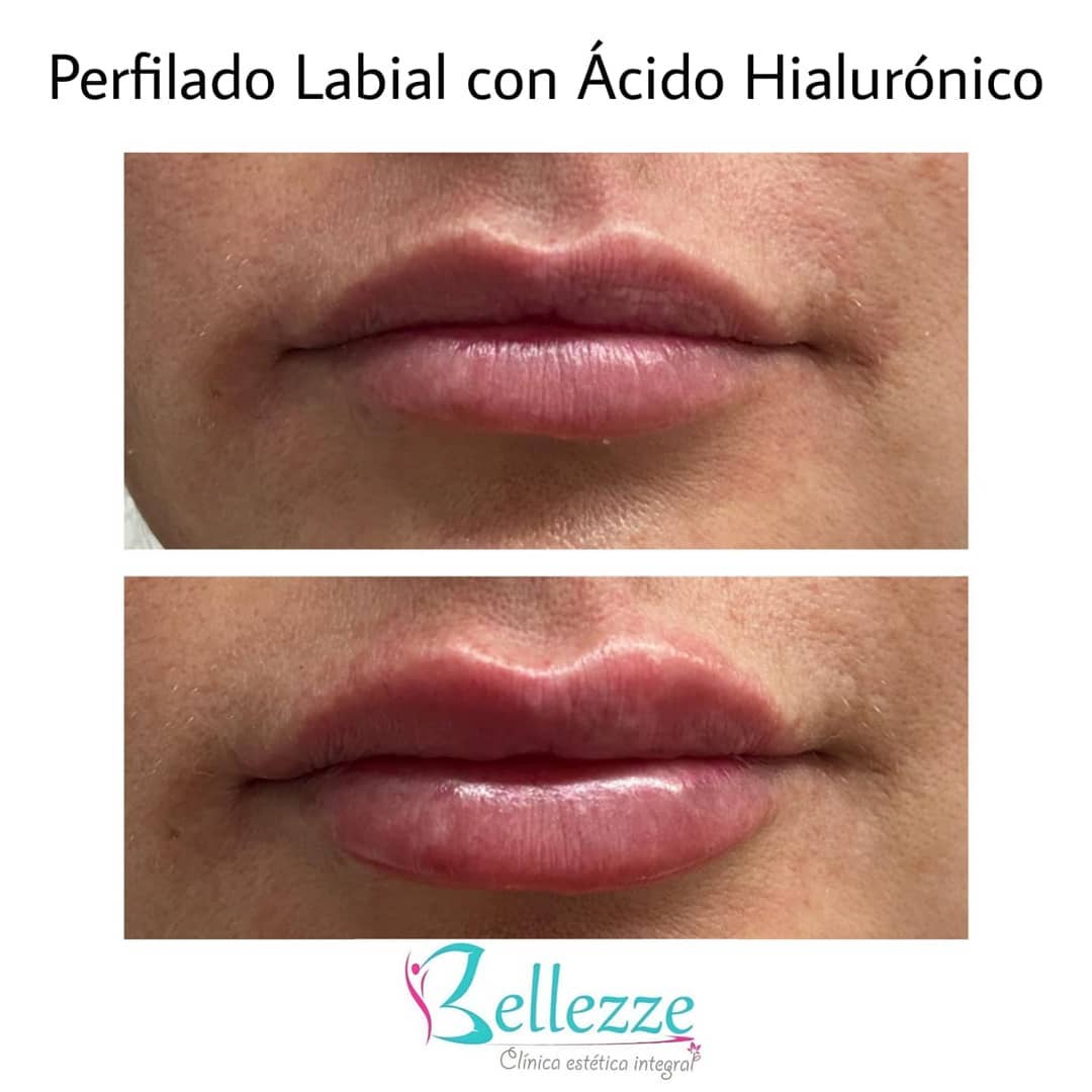 Clínica Rinnova - El perfilado de labios con ácido... | Facebook