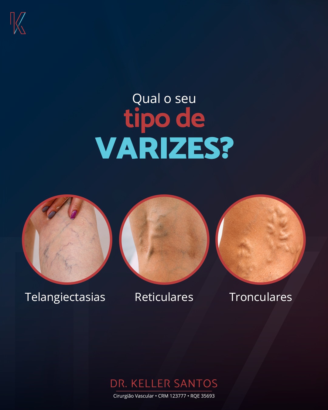 Dr. Keller Santos - Cirurgião Vascular - 📍A Radiofrequência é uma das ...
