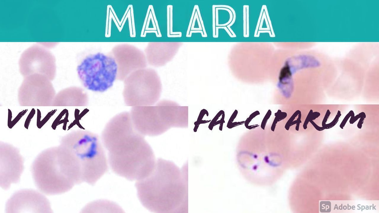 Jerad - #Malaria blood smear. How to distinguish plasmodium vivax from ...