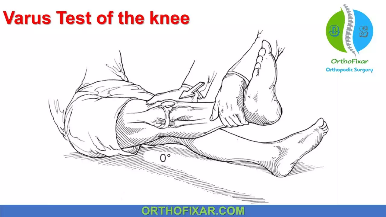 OrthoFixar - Orthopedic... - OrthoFixar - Orthopedic Surgery