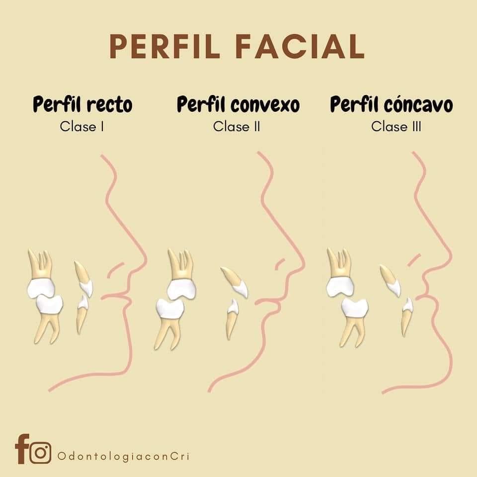Tipos de perfil facial:... - Dentallí - Depósito Dental