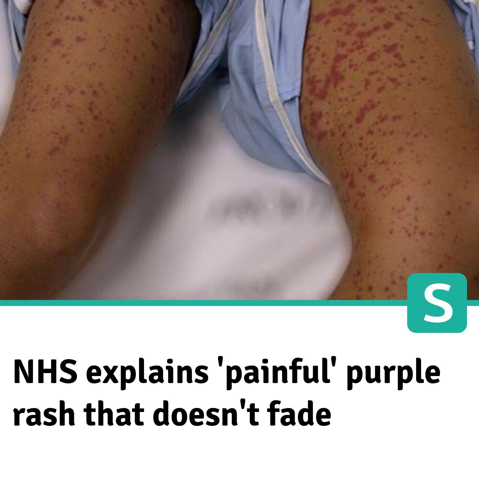 Surrey Live - The NHS is urging parents to watch for a... | Facebook