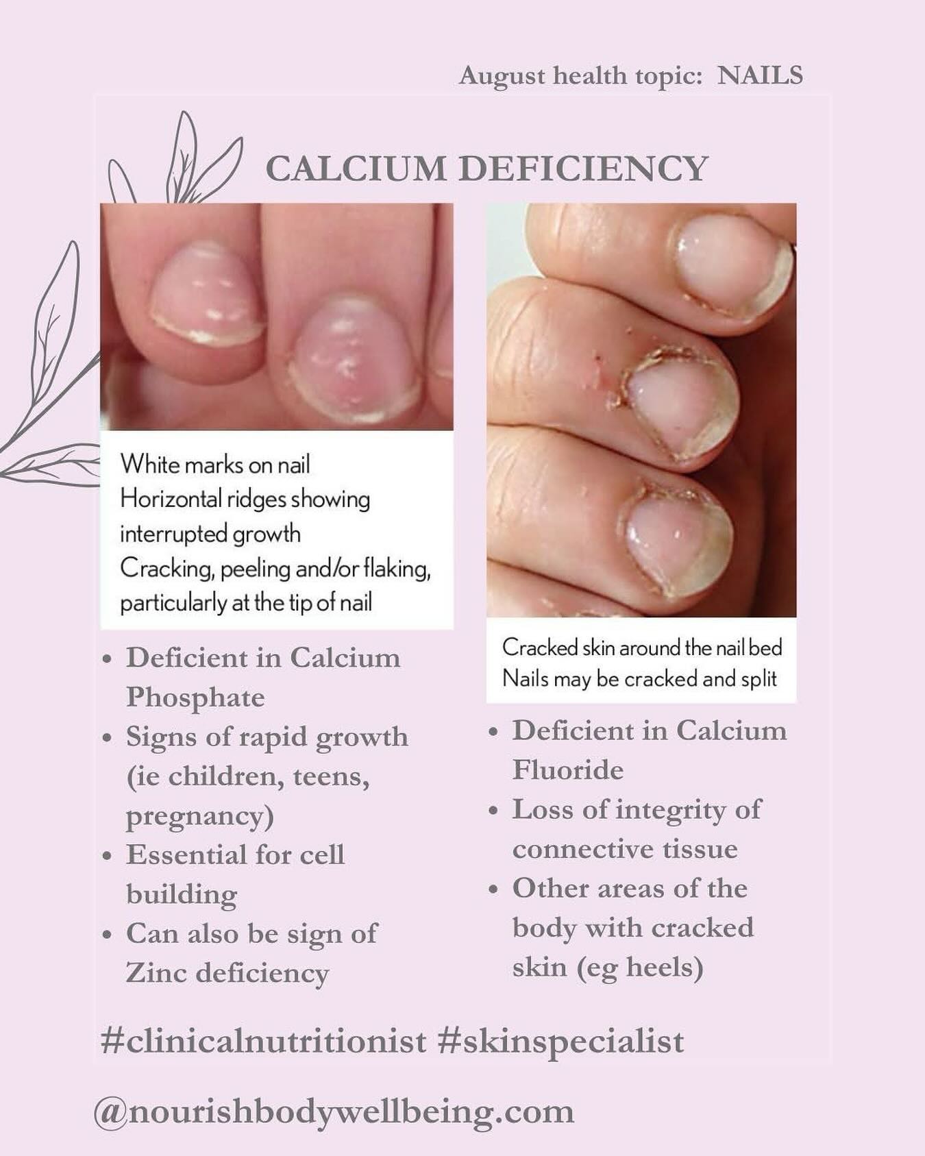 💅🏽 Nails that show cracked skin around the cuticles and nail bed ...