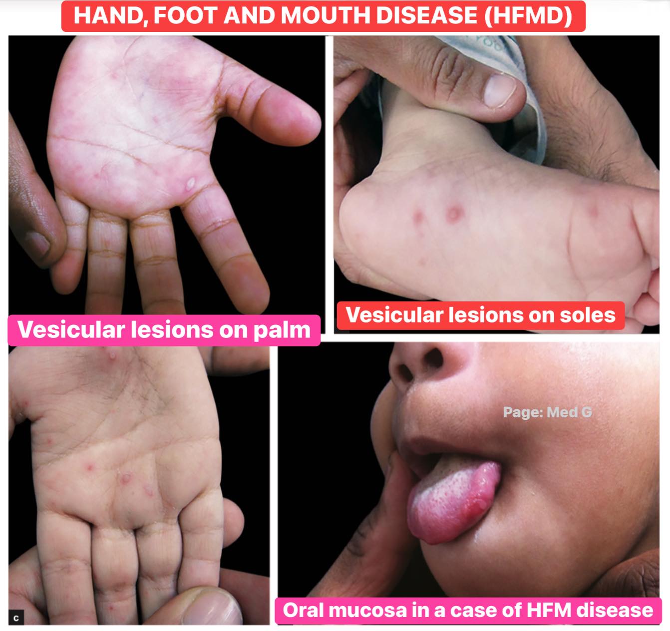 med-g-hand-foot-and-mouth-disease-hfmd-based-on-facebook
