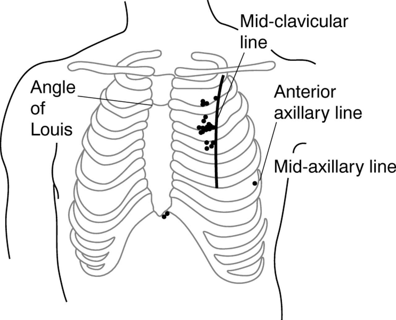 Cardiophilia - Tention Pneuothorax, RX: Immediate Decompress, by ...