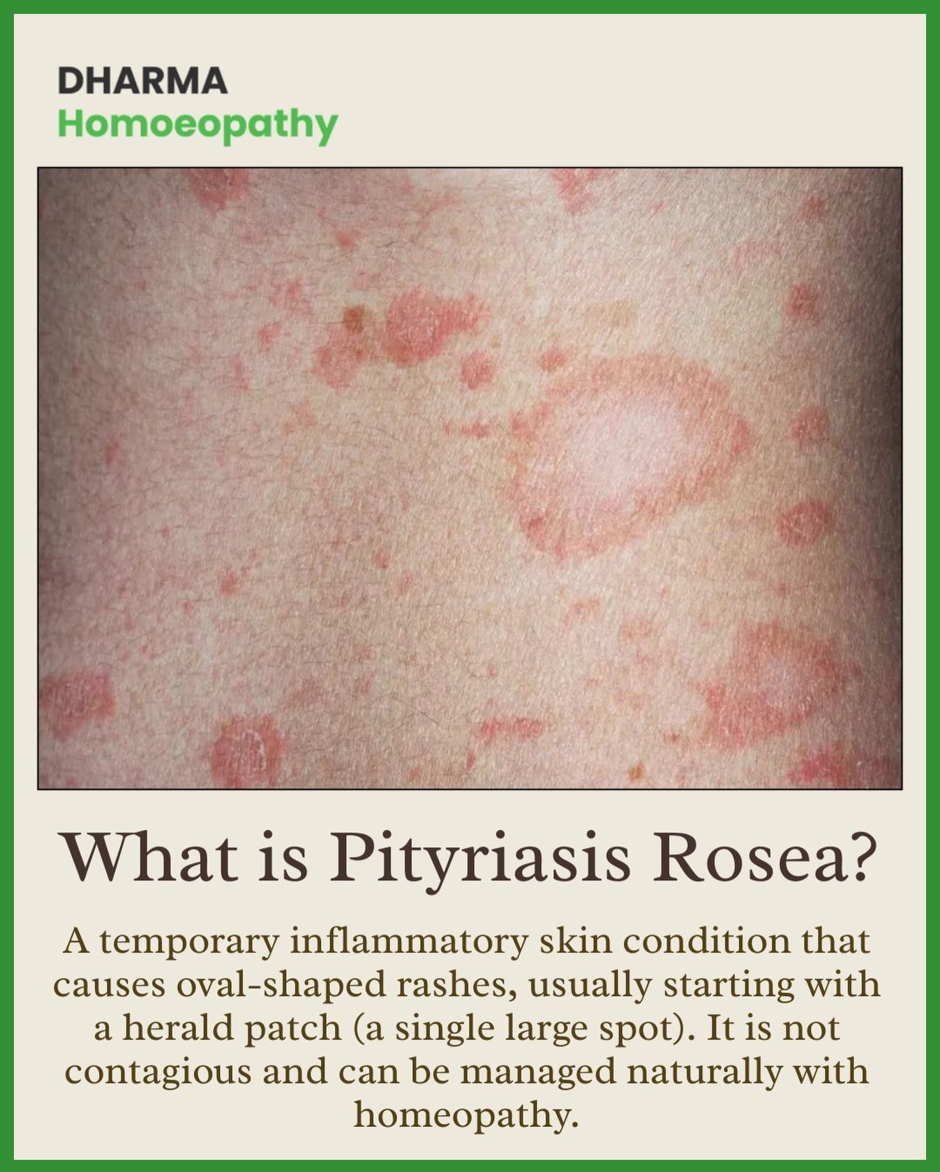 Dharma - Pityriasis Rosea is a harmless, non-contagious skin rash that ...