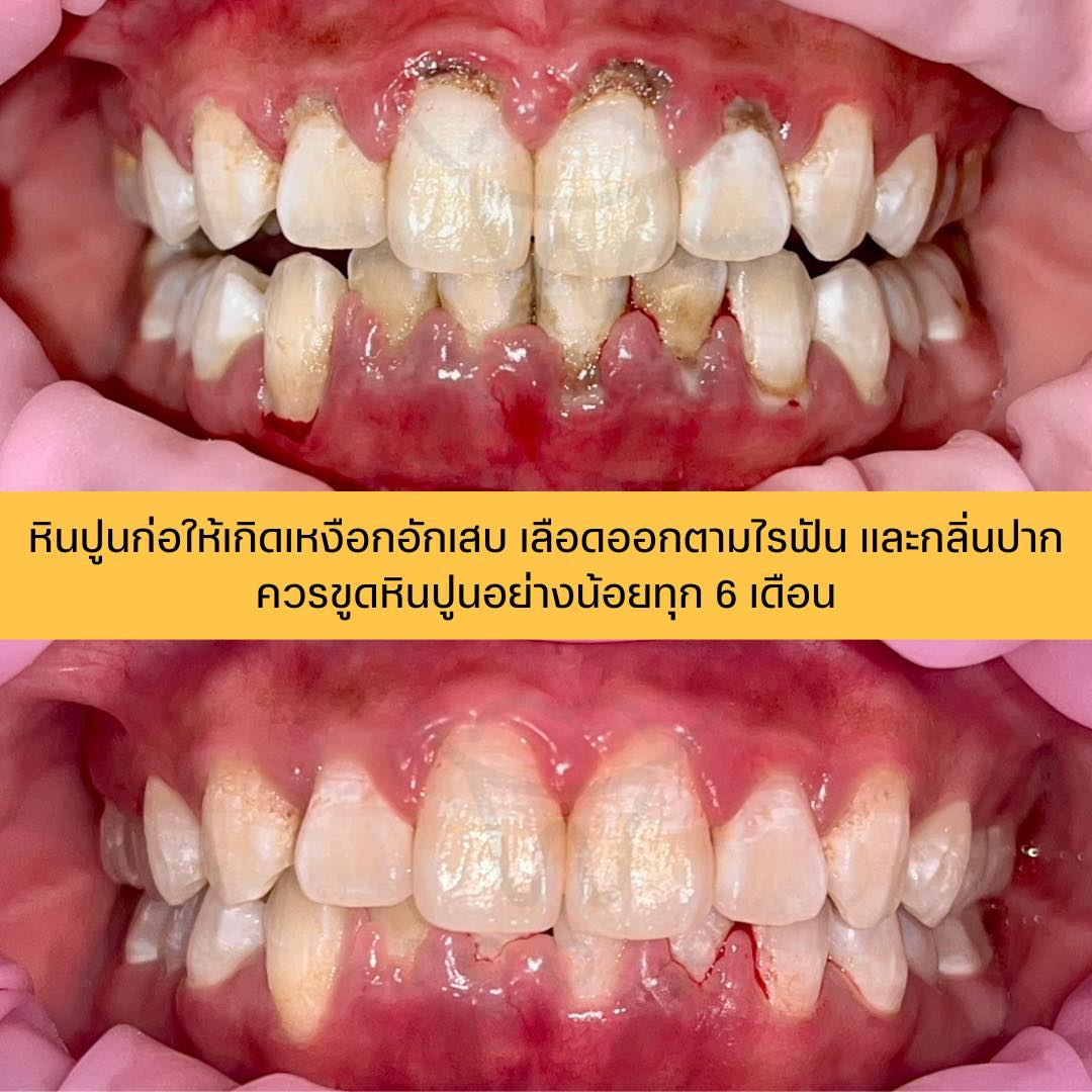 Tooth Corner Clinic - ทูธคอร์เนอะ สหคลินิก | Lam Luk Ka