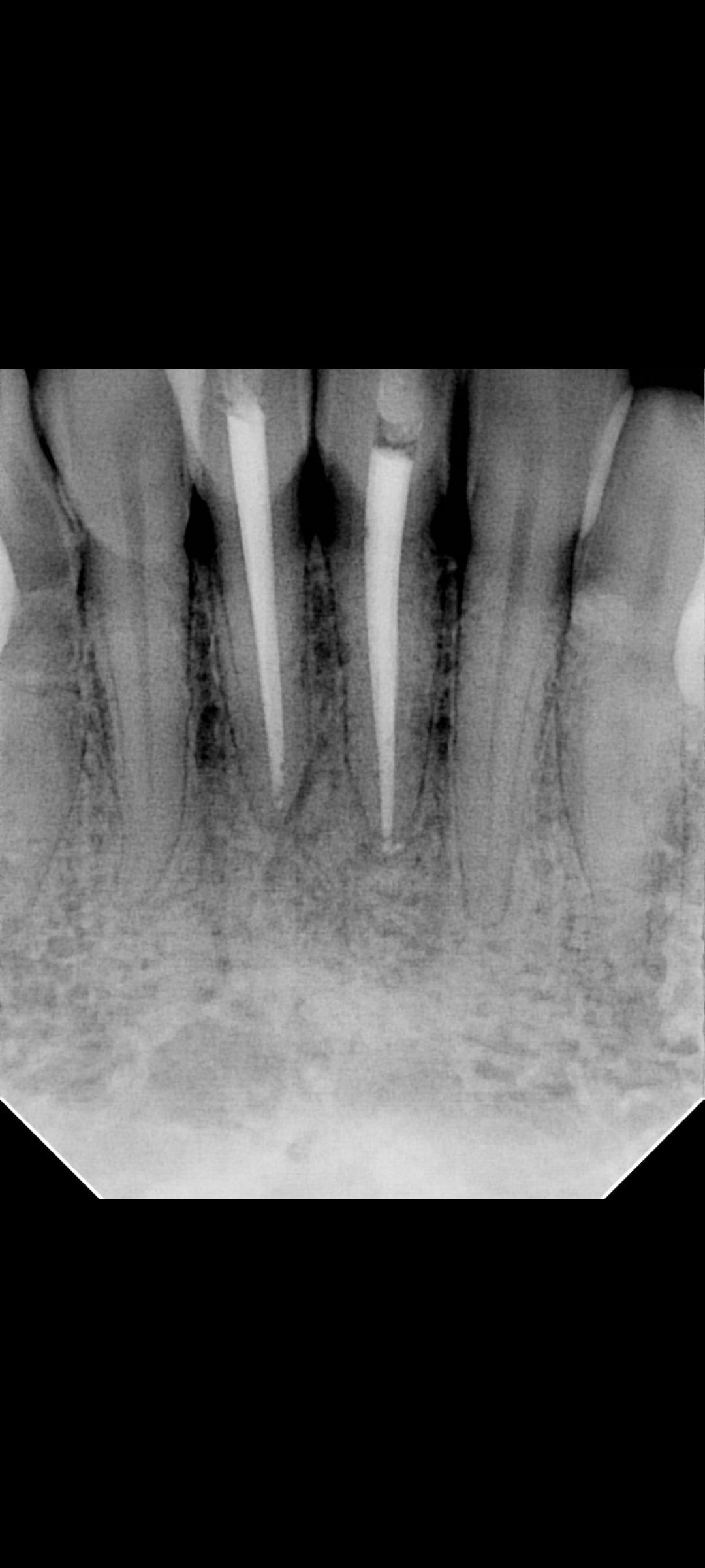 the ROOT CANAL REMOVAL Experience | Hi anyone here with the experience ...