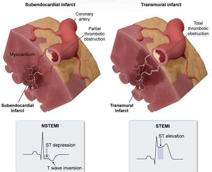 Cardiophilia - Awesome graphics illustrating the... | Facebook