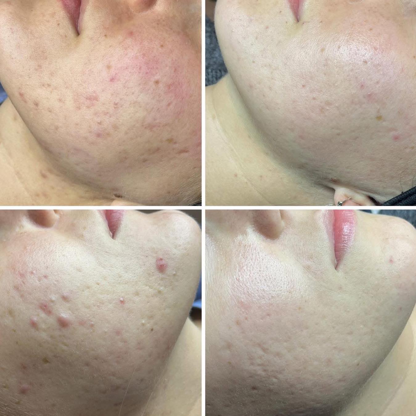 Malene's - Microneedeling👌🏼 Målet med behandlingen er at friske huden ...