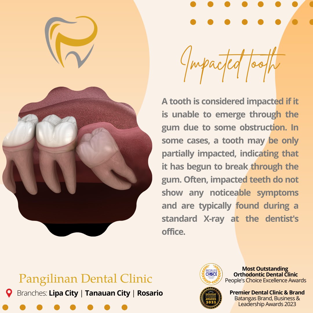 Pangilinan - A tooth is considered impacted if it is unable to emerge ...